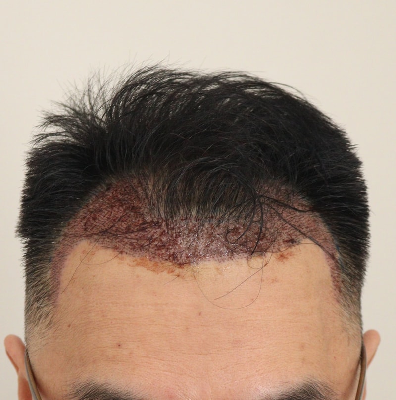 2. 수술후_1일.JPG