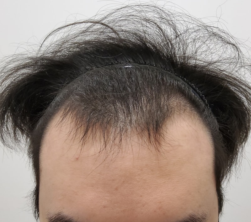 대학 입학 전 모발이식 받았어요