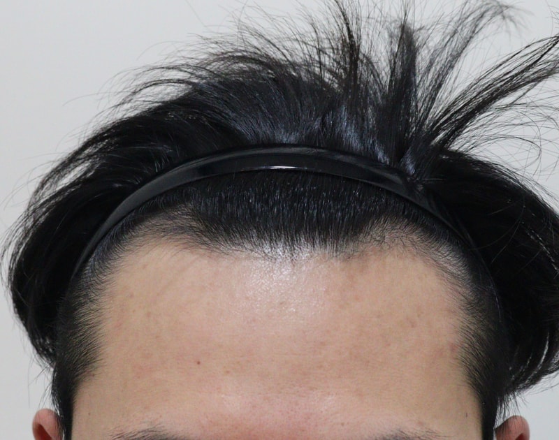 대다모에서 눈팅하다가 서울에서 모발이식 받음
