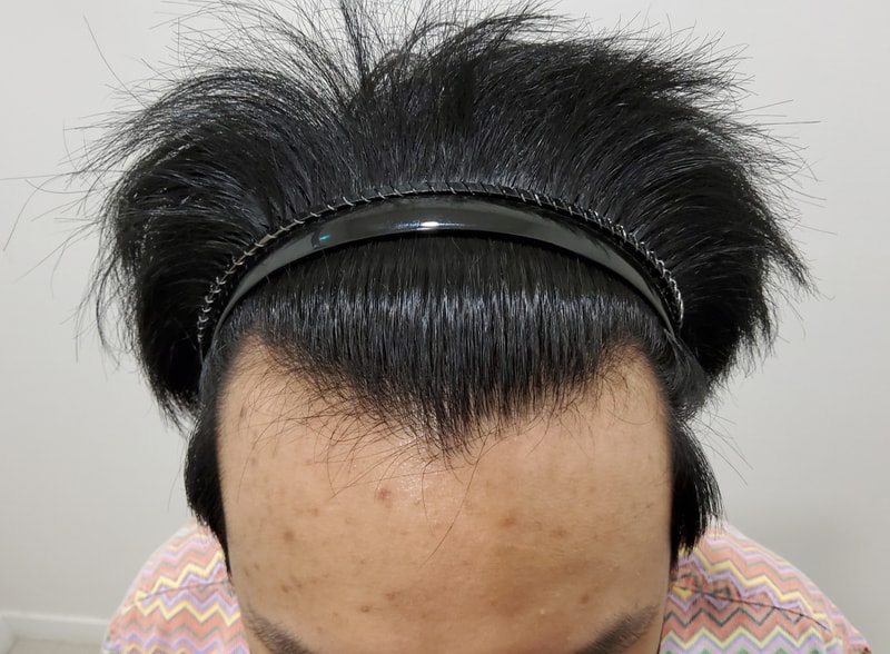 0. 수술전_1.jpg