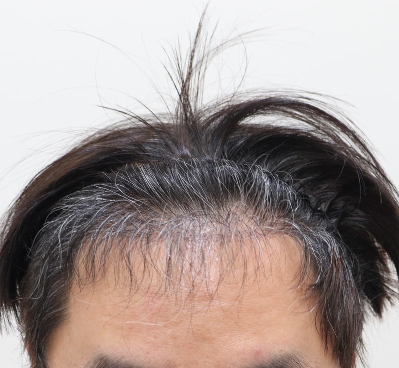 4. 수술후_6개월_1.JPG