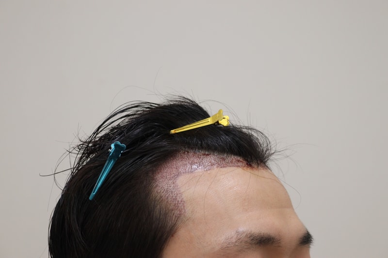 2. 수술후_1일_3.JPG