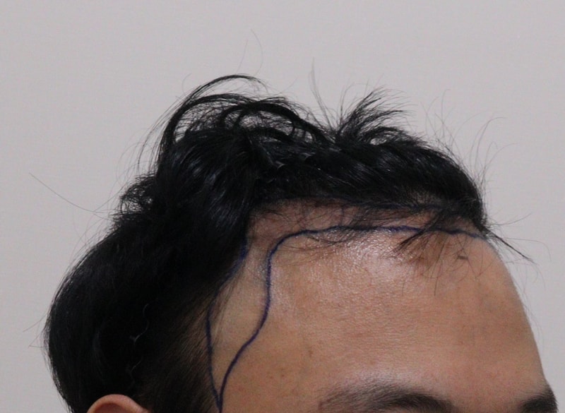 1. 수술전_3.JPG