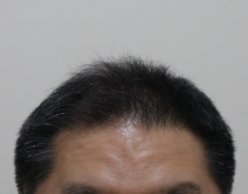 2. 수술후_3개월_1.JPG