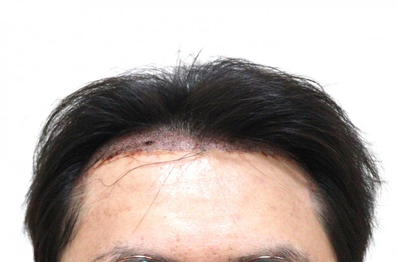 2. 수술후_1일_1.JPG