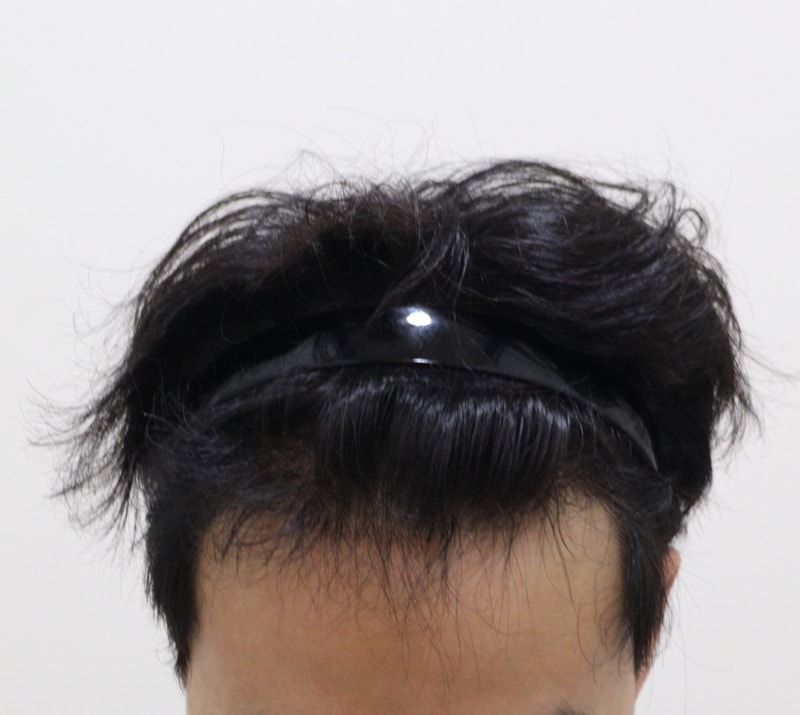 3. 수술후_6개월_1.JPG
