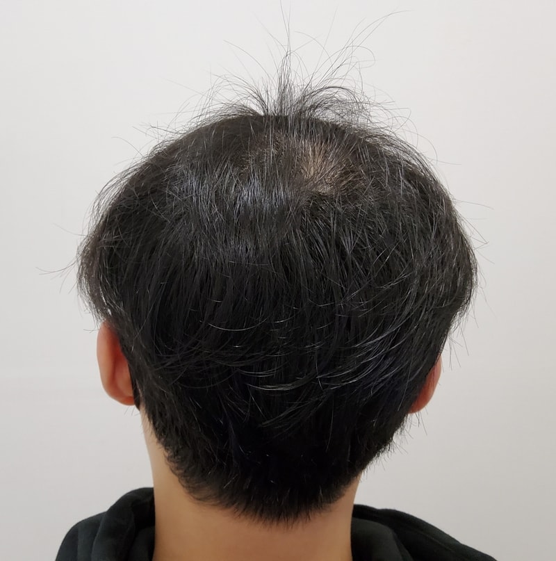 3. 수술후_3개월_2.jpg