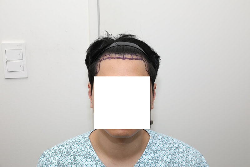 뉴헤어 비절개 2300모 6개월차 후기