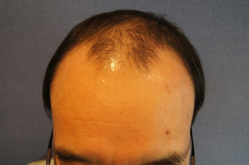 Motion 2,000 hair follicles, 1 year and 7 months