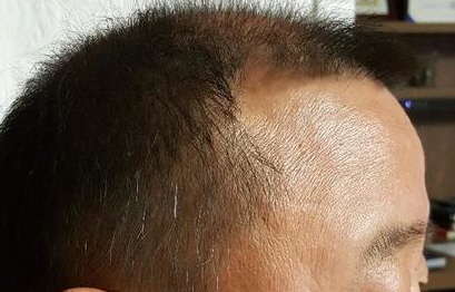 2000 hair follicles are approximately 4 months old
