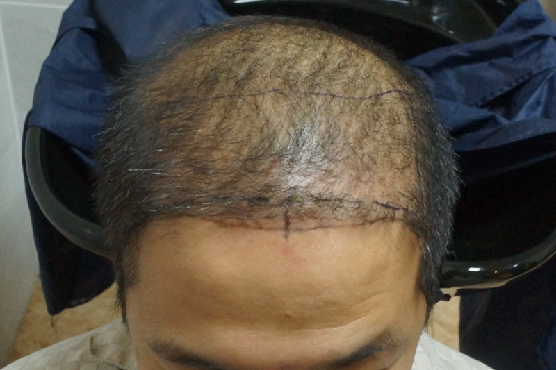 Motion 2200 hair follicle hair transplant 1 month