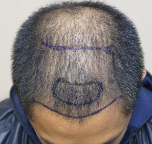 2000모낭 앞머리 밀도 수술 9개월 고민 생김