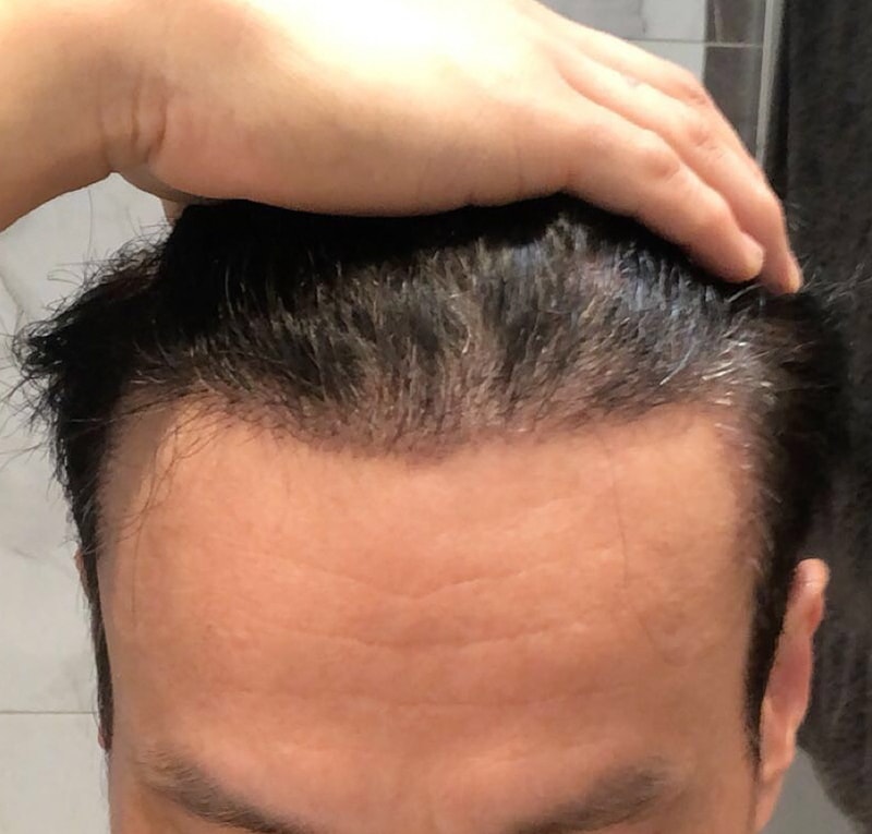 Motion 1400 hair follicle no-cutting reinforcement 15 days