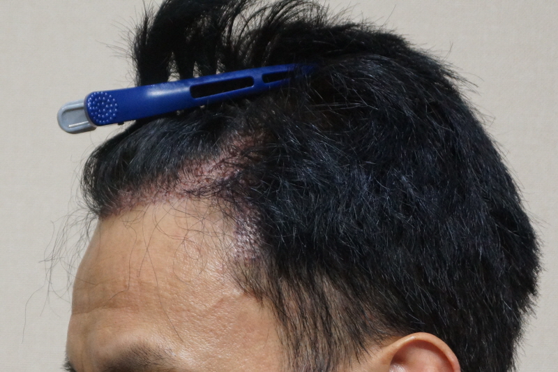 Motion 1400 hair follicle no-cutting reinforcement transplant 2 months