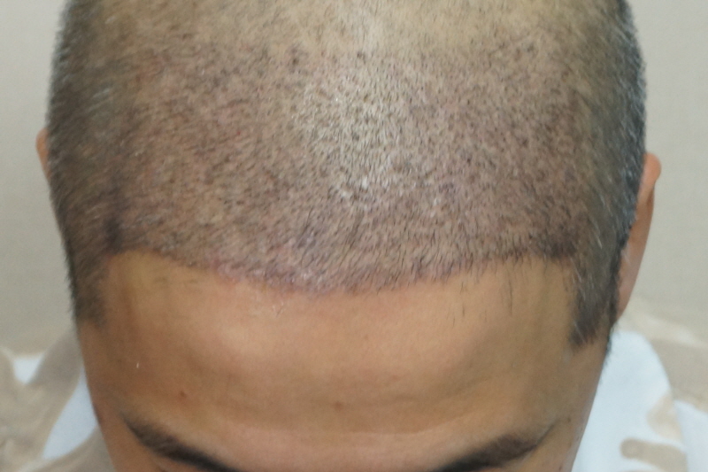 Motion 2200 Hair follicle hair transplant 12th day to remove scabs