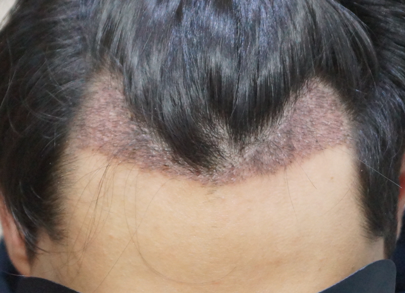 1000 follicles transplanted and scabbed