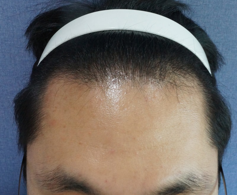 1300모낭 비절개 모발이식 1년 경과