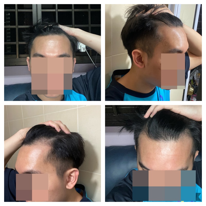 1600모낭 비절개 15개월
