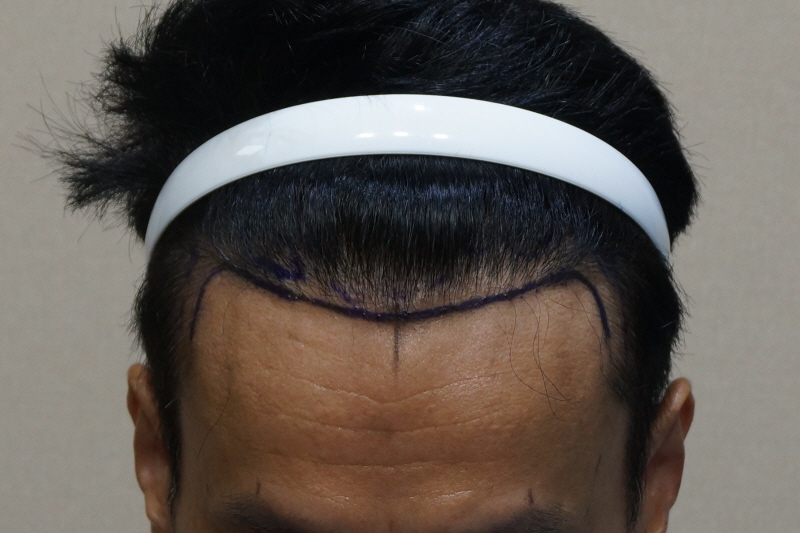 Motion 1400 hair follicle no-cutting reinforcement transplant for 5 months