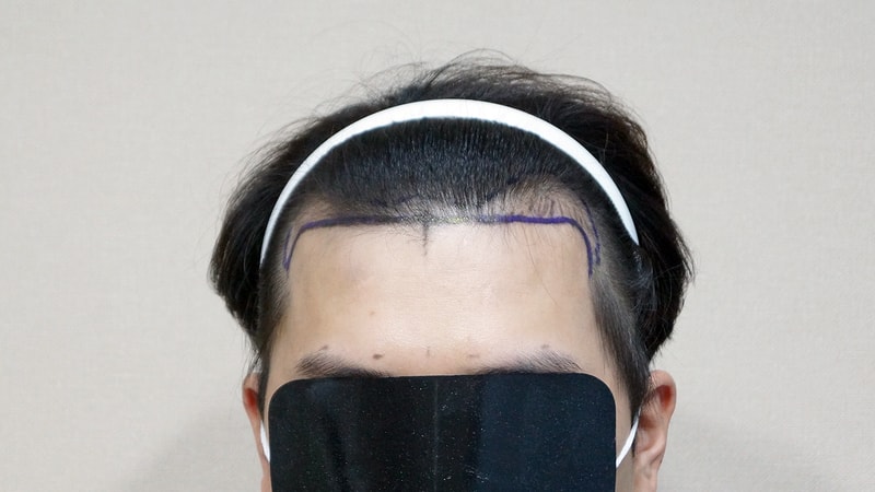 Non-cut 1200 hair follicle hair transplantation 8 months later