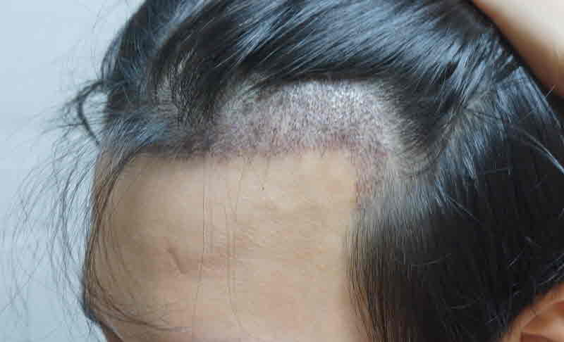 It's been a month since my hair transplant
