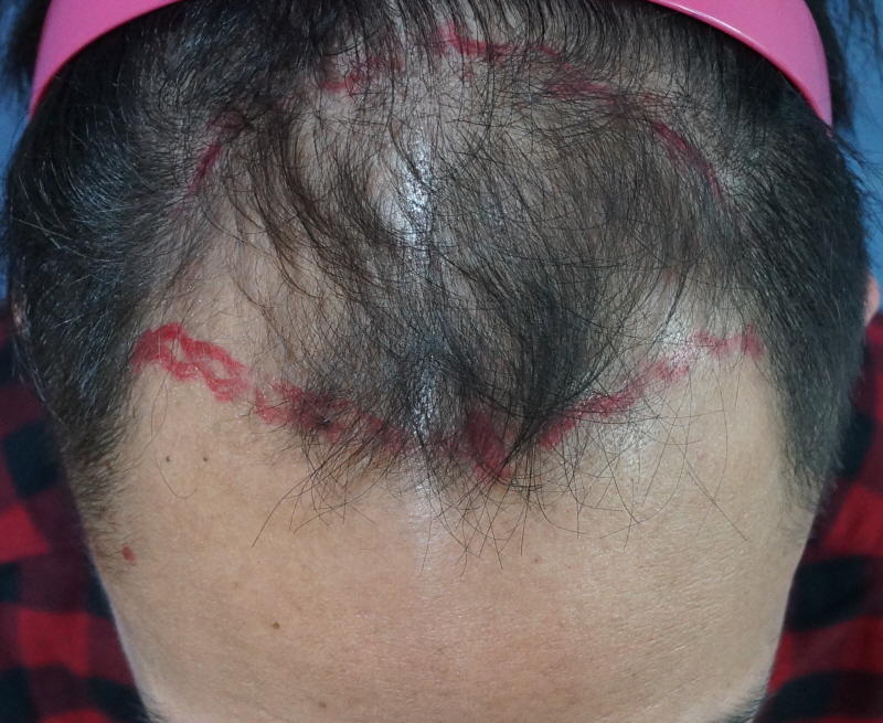 Evaluation of Motion Non-Cutting 2000 Hair Orthography