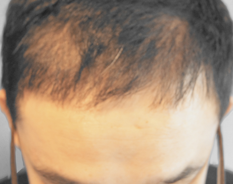 모션 앞머리 이식 두달 후기