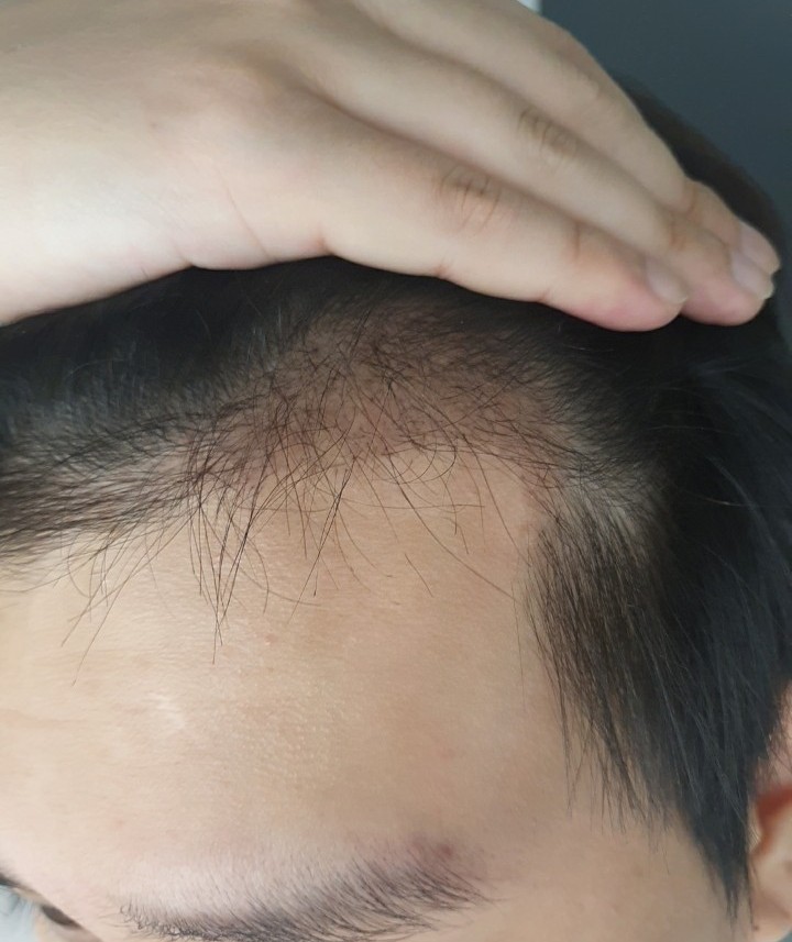 80 days after the hair transplant