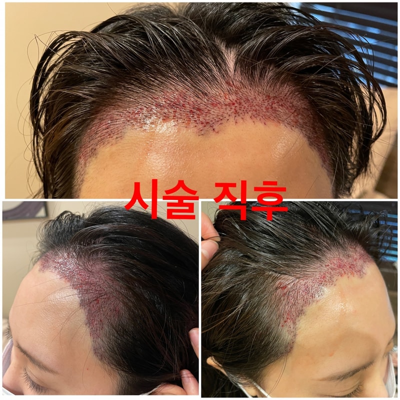 찐후기 헤어라인 시술 (압구정 모우림의원) 2500모 (전/후 사진첨부)