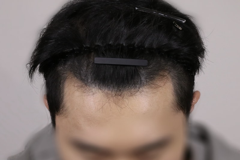 압구정 모우림의원에서 모발이식 2900모 (헤어라인+구렛나루) 수술 후기입니다. 도움이 되셨으면 좋겠네요
