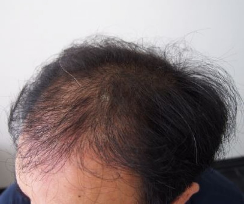 모재성 2300모 비절개 1년경과 후기