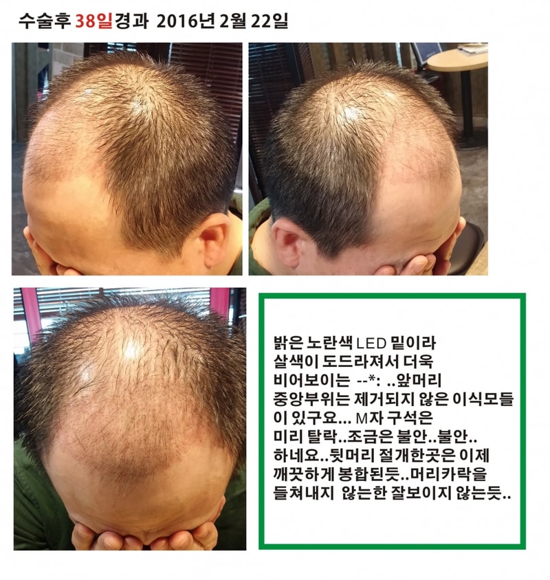 절개 비절개 혼합 5120모 수술후38일경과