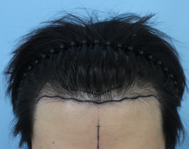 수술후기(수술전 디자인).png