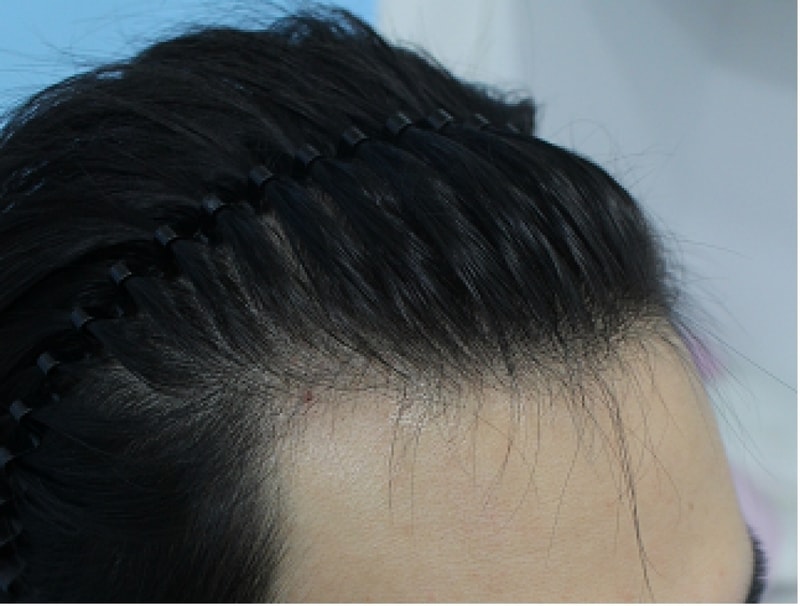 수술후기(수술전 측면).png