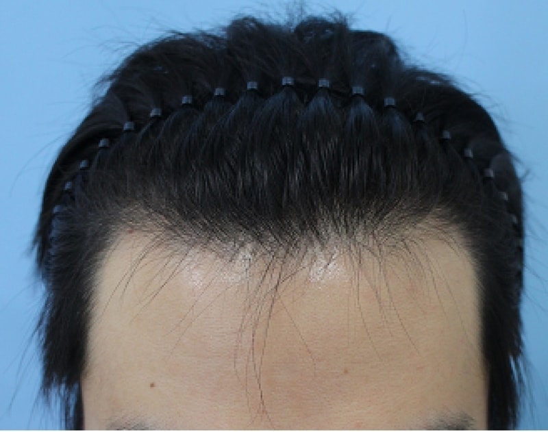 수술후기(수술전정면).png