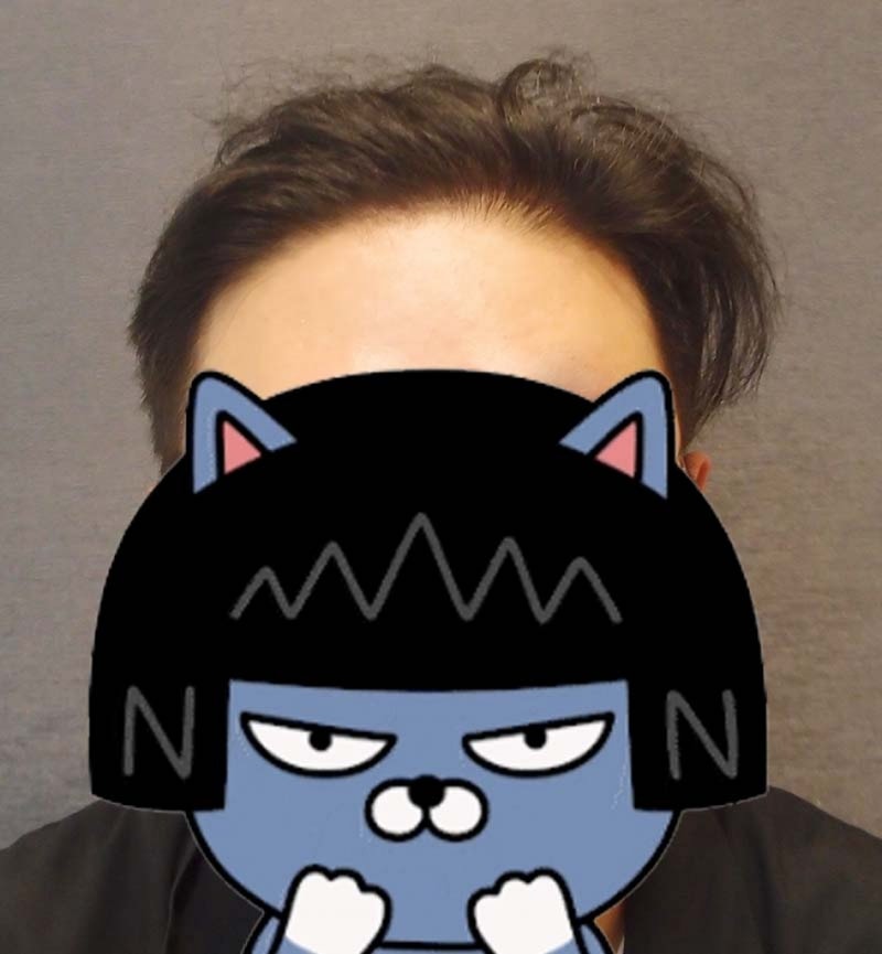 수술후1년3.jpg