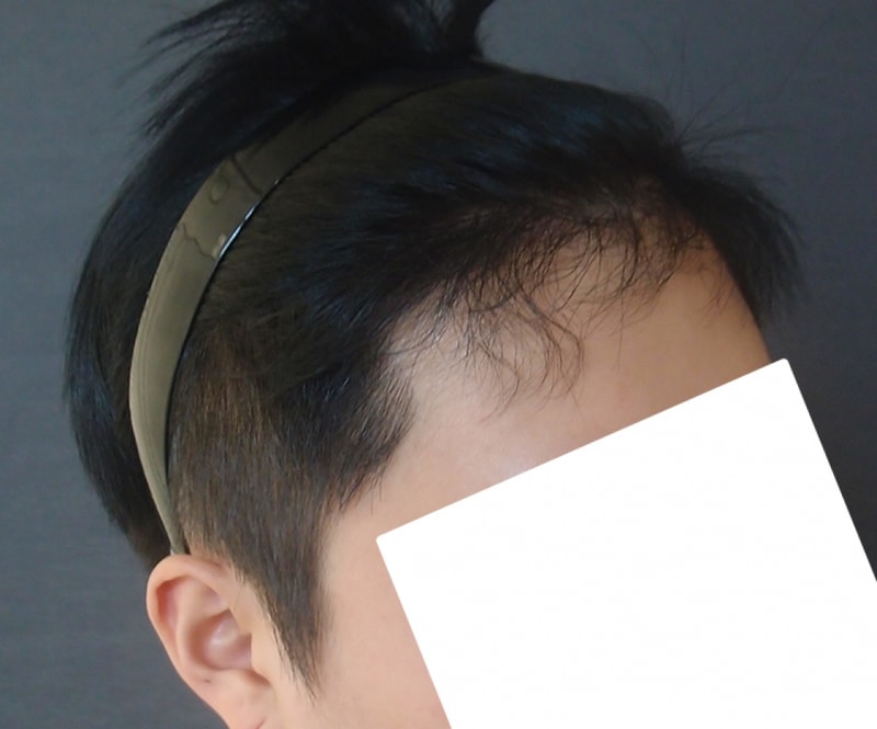 수술후6개월_3.jpg