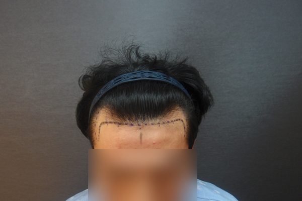 수술전1.jpg