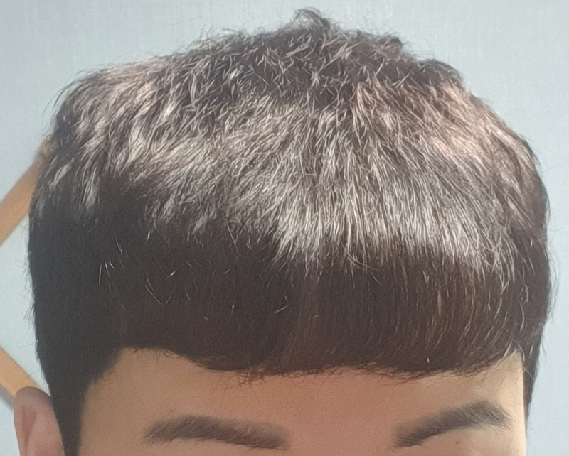 수술 8개월 앞머리 내린거.png