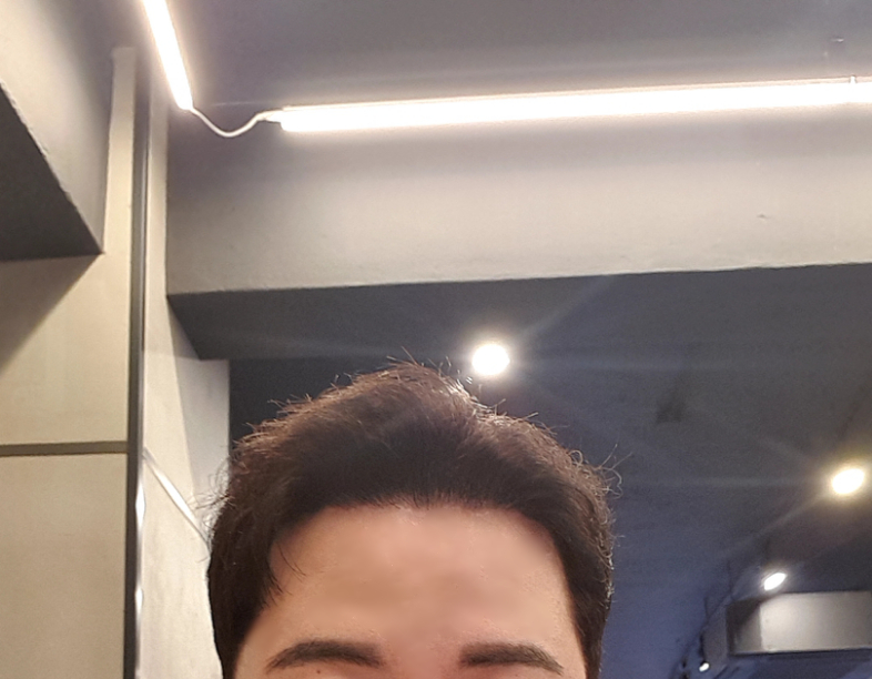 수술 8개월 앞머리 올린거.png