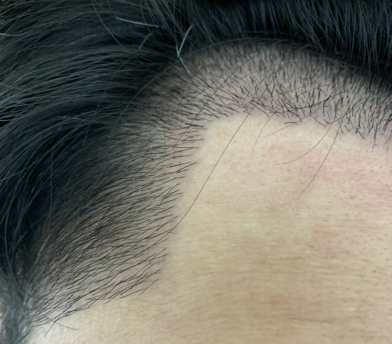 M자 비절개 투블럭 3000모 (수술 7일차 ~ 17일차)