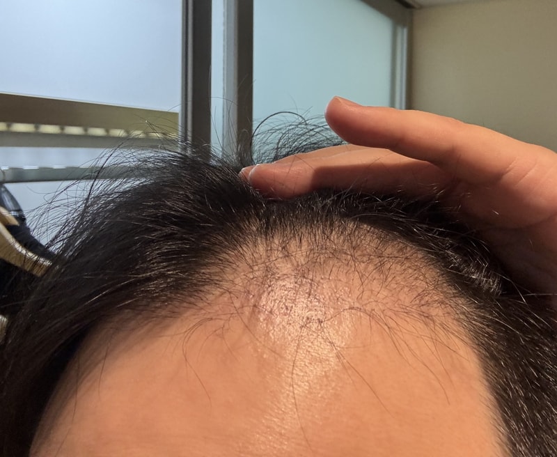 뉴헤어모발성형외과 모발이식 1800모낭 후기