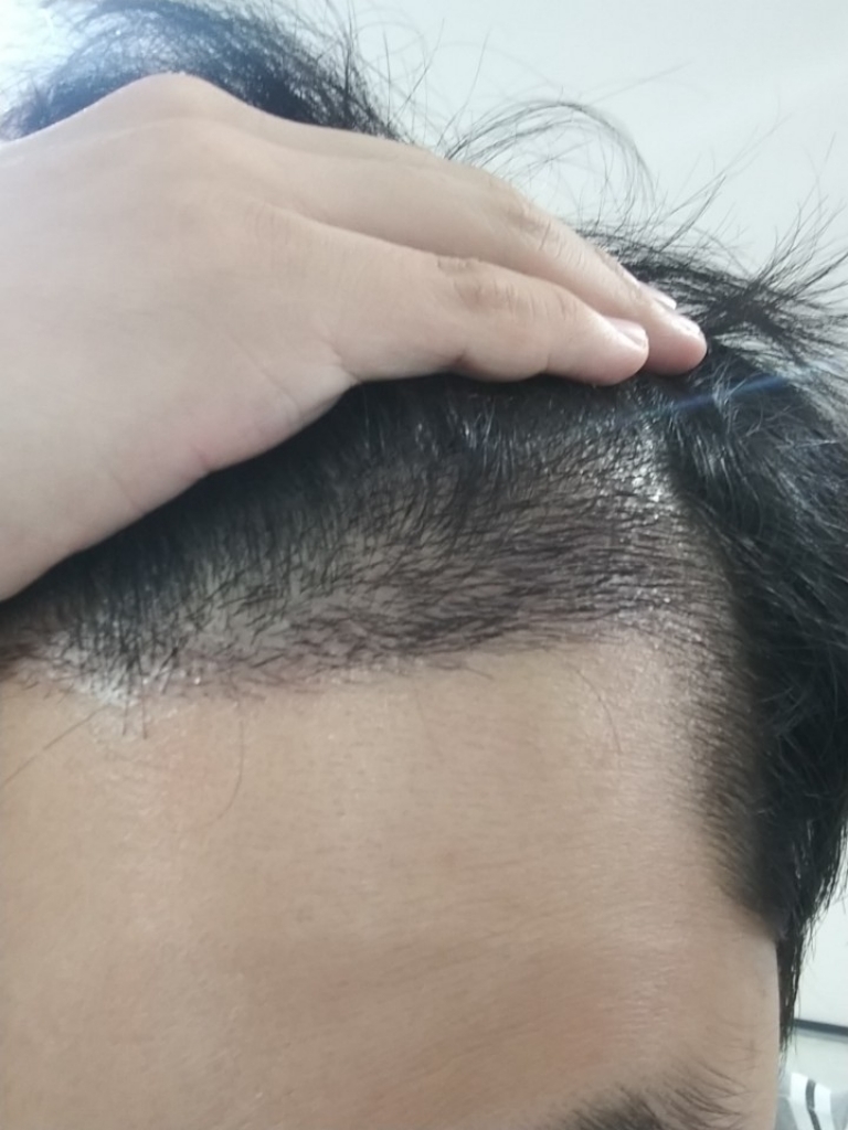 수술 10일 지나고 후기/붙임머리/딱지제거/사회생활가능여부