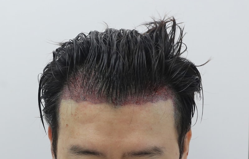 수술후.jpg