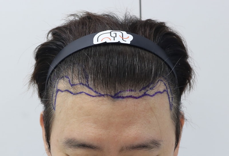 수술전.jpg