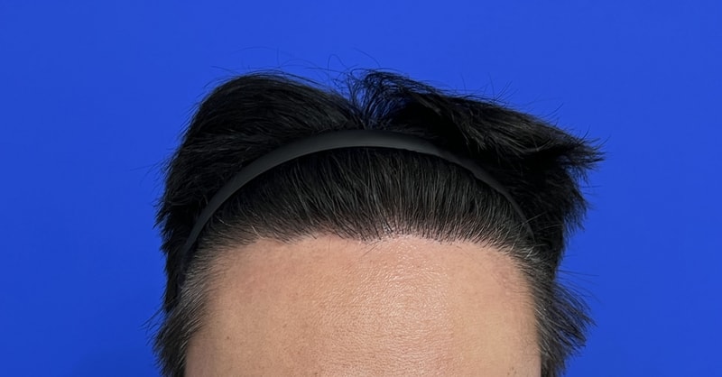 모디헤어 M자탈모 3000모 1년 3개월차입니다