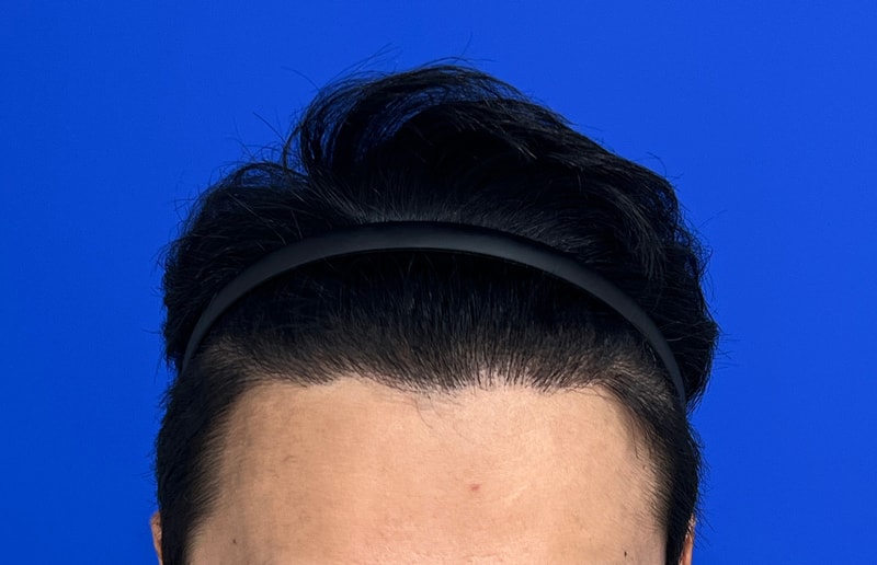 수술후12m 1.jpg