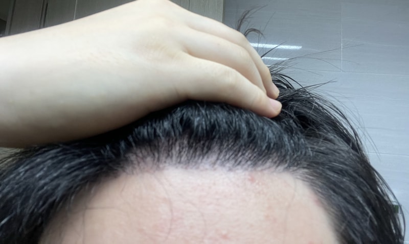 3. 수술후_6개월_셀카1.jpg
