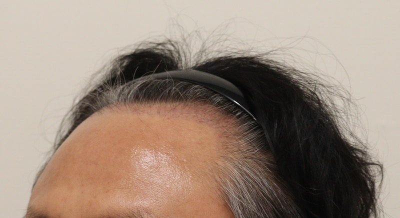3. 수술후_3개월_3.JPG