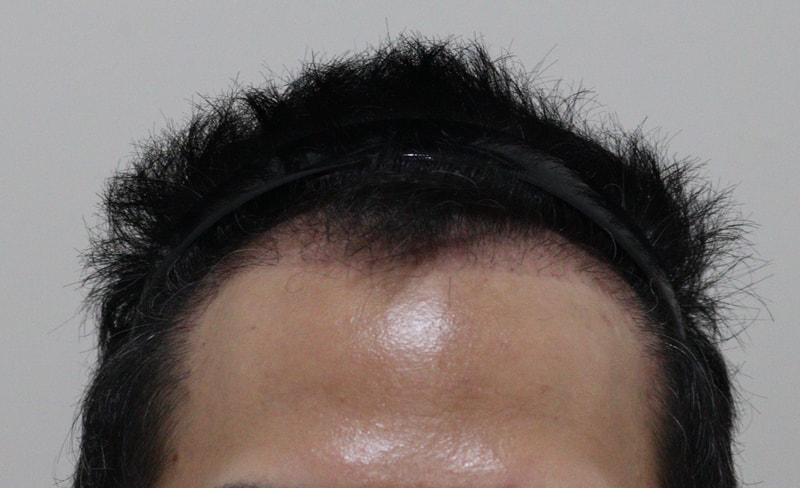3. 수술후_3개월_1.JPG